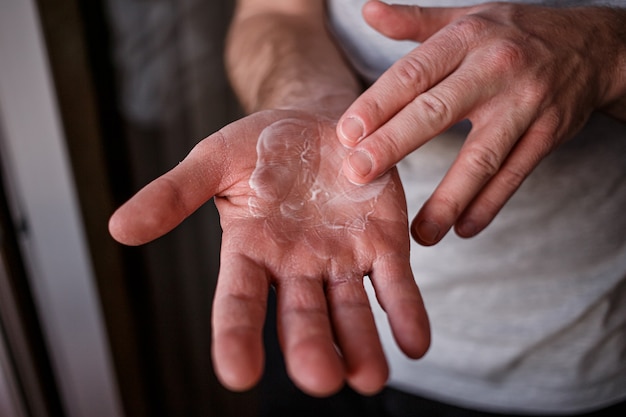 Man putting moisturizer onto his hand with very dry skin and deep cracks with cream due to washing alcohol