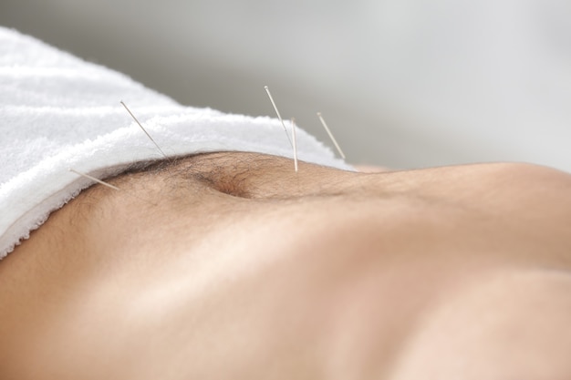 Pancia dell'uomo con gli aghi. concetto di agopuntura