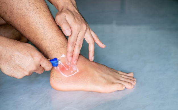 Man's hand is applying painkiller to his ankle due to pain ankle inflammation sprained ankle irregular gait health problems from being overweight