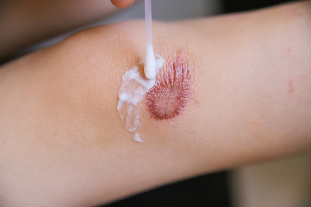 A man\'s hand smears cream on the damaged skin on the child\'s\
leg. dry skin and irritation. allergic reactions.an abrasion and a\
scratch on the knee.