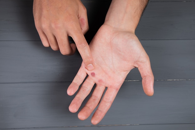 A man shows a callus on a gray wall