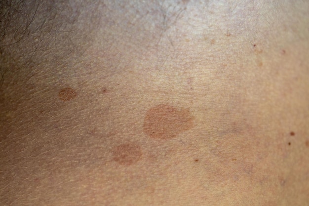 Man suffering from the skin condition Tinea Versicolor with discolored patches on the skin