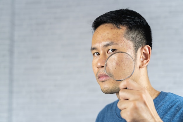 Man wijzend op acne Ontstoken optreden op zijn gezicht.