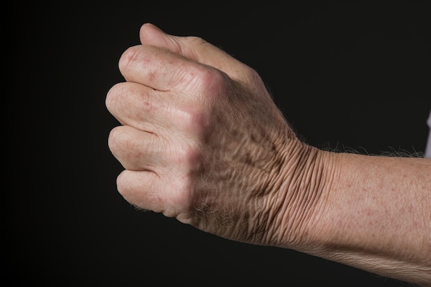 Photo man with atopic eczema closeup on arm skin problem