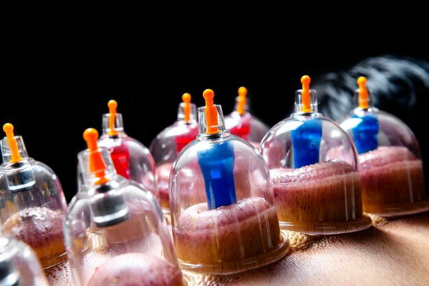 Man with cupping treatment on the back with black background