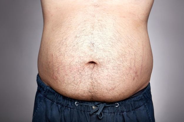 A Man with Excessive Belly Fat and Stretch Marks on Grey Background