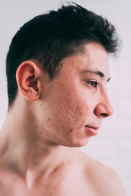 Man with problematic skin and scars from acne