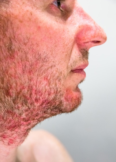 ひげの領域に脂漏性皮膚炎を持つ男性