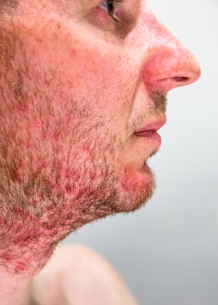 Man with seborrheic dermatitis in the beard area