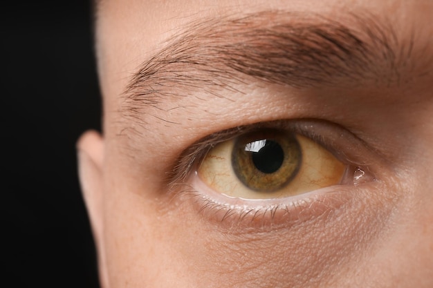 Man with yellow eyes on black background closeup Liver problems symptom