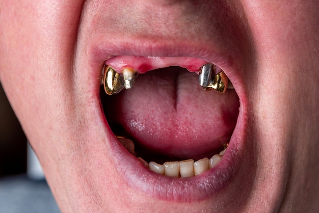 Photo a man without upper front teeth inserting teeth