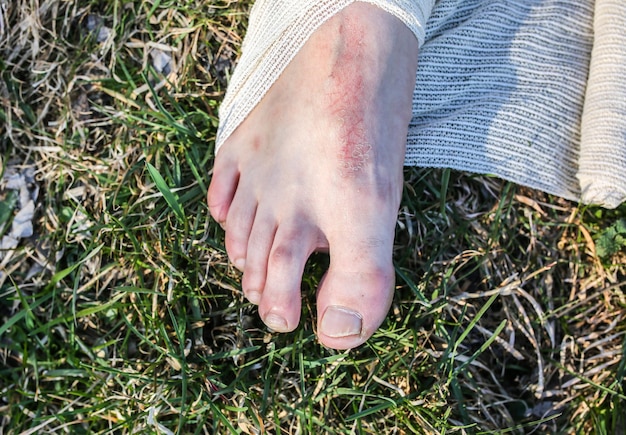 Man zet verband op verstuikte enkel. Gedraaid been. Persoon zit in de natuur. Op blote voeten op het gras. Droge kras en wond. Gewonde toerist. Wandelen op ongemakkelijke schoenen. Blaar op teen.