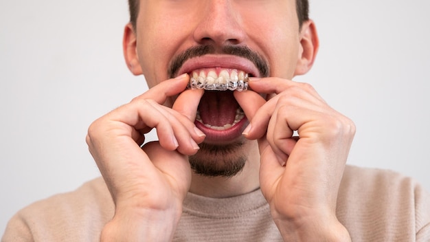 Mannenhand die tandheelkundige aligner-houder van tandheelkundige kliniek aanbrengt voor behandeling van mooie tanden Orthodontische verwijderbare stijltangen in tandartspraktijk