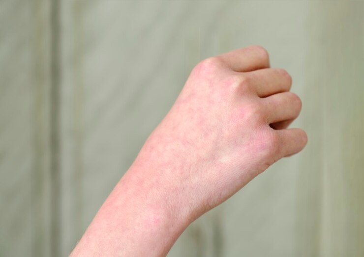 Marbling skin syndrome. Cutis marmorata telangiectatica congenita is a rare congenital disease, vascular pathology