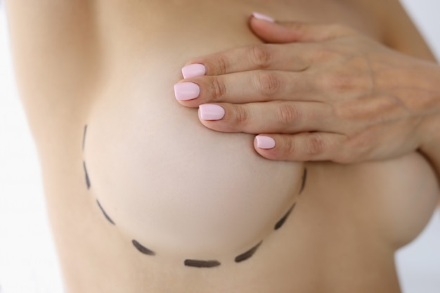 Markings are applied on female breast before plastic surgery mammoplasty