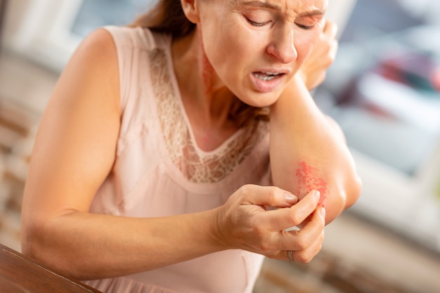 Mature woman feeling pain having reddening on neck and elbows suffering from allergy