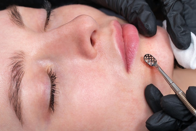 mechanische acneverwijdering van het gezicht van een patiënt in een schoonheidssalon