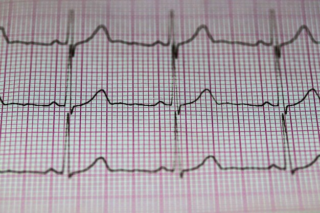 Photo medical care electrocardiogram high blood pressure