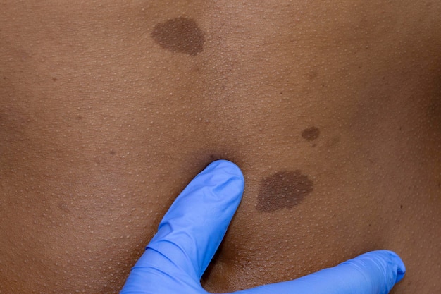 Medical dermatologist examines benign moles in African patientxA