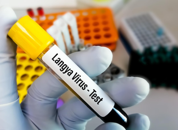 Medical laboratory scientist holding blood sample for Langya virus test