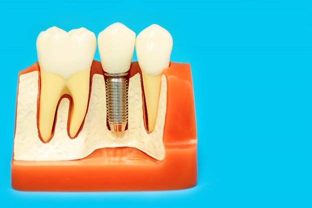 Medical model of the jaw with false teeth on a pin on blue background