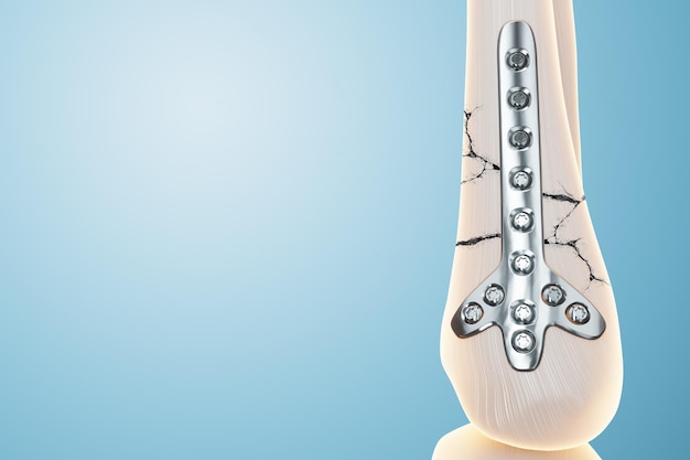 Procedura medica operazione di osteosintesi riposizionamento chirurgico delle ossa delle gambe fissaggio di un osso rotto con una tecnologia a piastra metallica fissazione di una frattura 3d rendering illustrazione 3d