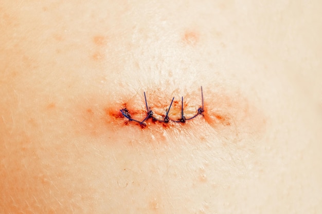Medical sutures after operations sewn surgical sutures on the\
human body