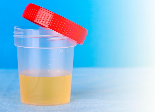 Foto test medico delle urine in contenitore di plastica aperto su sfondo blu