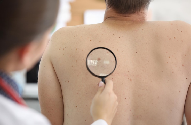 Photo medical worker checking birthmark