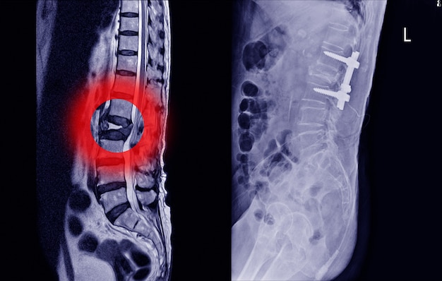 Medical X-ray Lumbar spine compression fracture On red arrow point