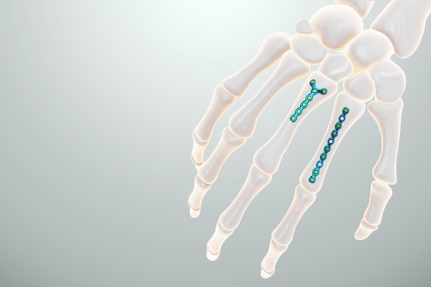 Medische procedure osteosynthese operatie chirurgische herpositionering van de botten van de vingers Fixatie van een gebroken bot met een metalen plaat fixatie van een breuk 3D render 3D illustratie