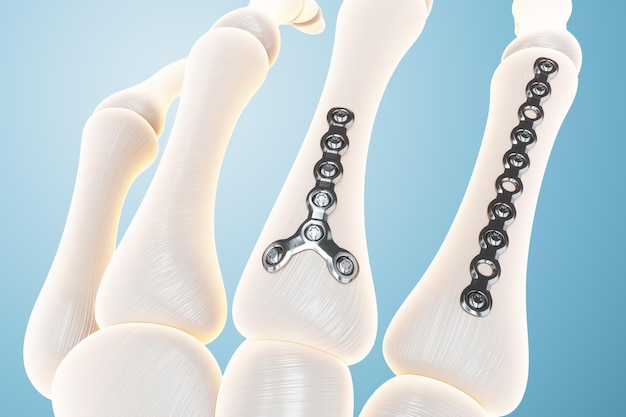 Foto medische procedure osteosynthese operatie chirurgische herpositionering van de botten van de vingers fixatie van een gebroken bot met een metalen plaat fixatie van een breuk 3d render 3d illustratie