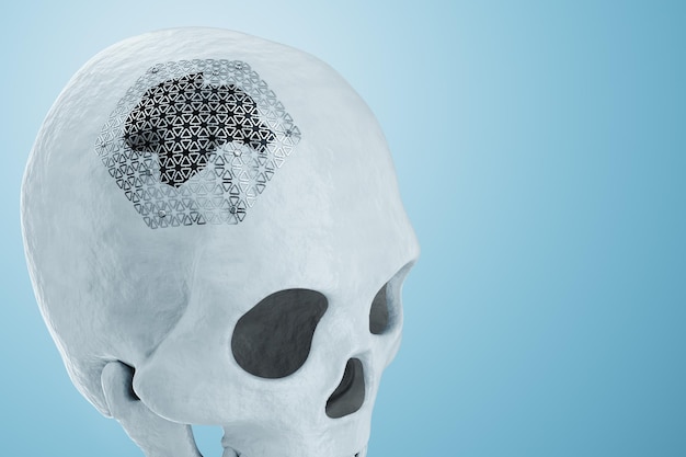 Medische procedure osteosynthese operatie chirurgische herpositionering van de schedel Fixatie van een gebroken bot met een metalen plaat technologie fixatie van een breuk 3D render 3D illustratie