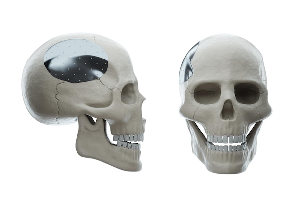 Medische procedure osteosynthese operatie chirurgische herpositionering van de schedel Fixatie van een gebroken bot met een metalen plaat technologie fixatie van een breuk 3D render 3D illustratie