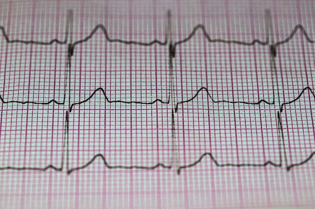 Foto medische zorg elektrocardiogram hoge bloeddruk