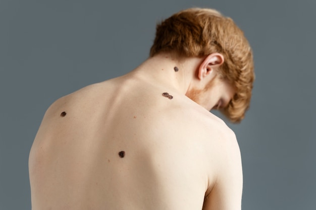 Photo medium shot young man with moles on back