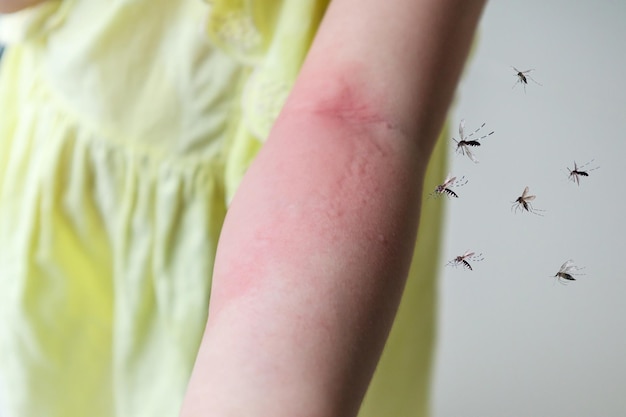 Meisje heeft allergie voor huiduitslag en jeuk op haar arm door muggenbeet