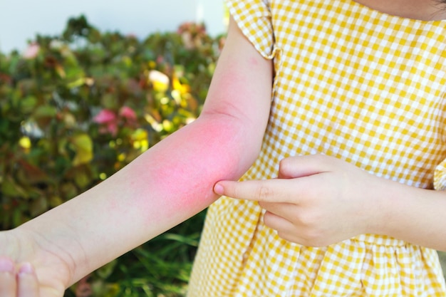 Meisje heeft allergie voor huiduitslag en jeuk op haar arm