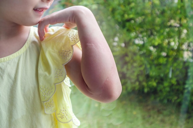 Meisje heeft allergie voor huiduitslag en jeuk op haar arm