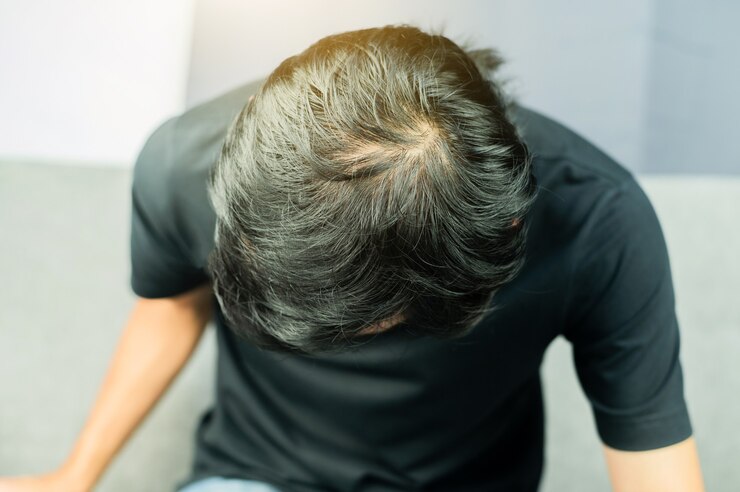 남성은 탈모, 가늘어지는 모발, 대머리에 문제가 있습니다.