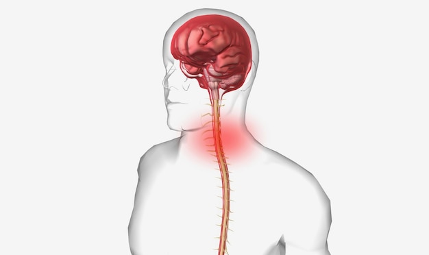 Photo meningitis is the inflammation of the meninges