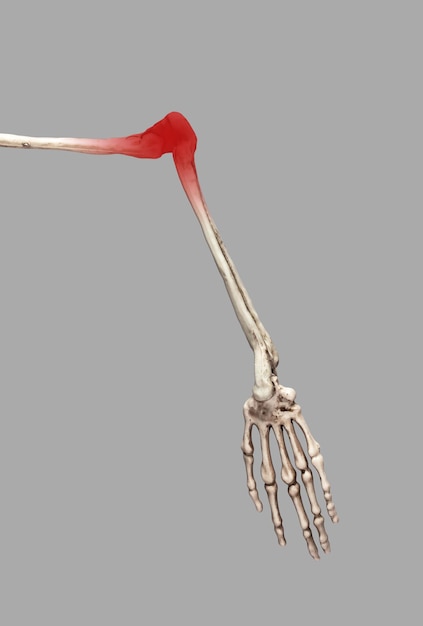 Menselijk skelet arm met rode elleboog Sport trauma letsel overmatig gebruik ontsteking gevolgen Pijn zwelling roodheid Gezondheidsproblemen anatomie concept