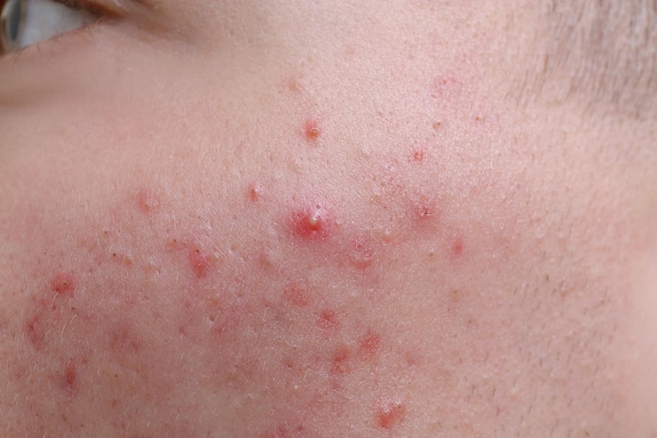 Foto menselijke huid met acne close-up