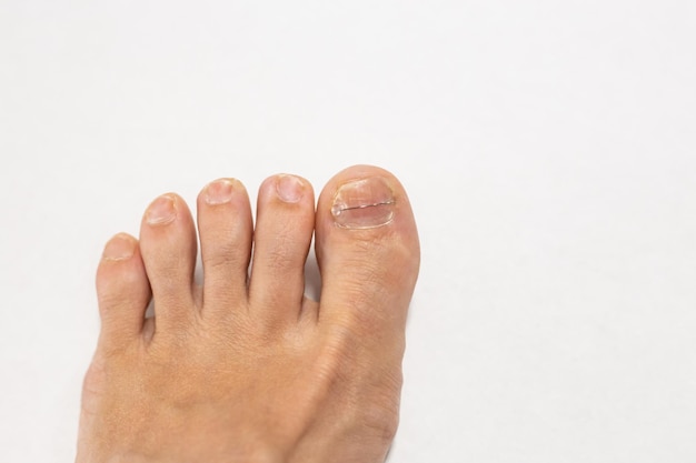 Photo metal on the foot toenails podiatrist work pedicure steel cover ingrown toenail treatment