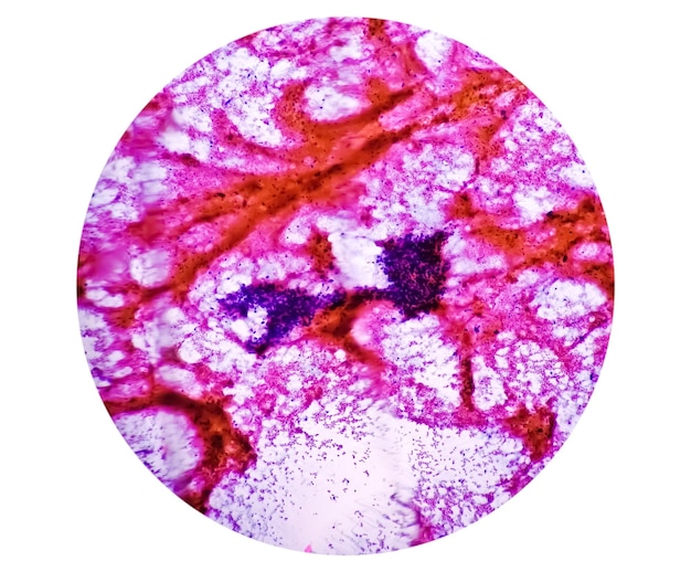 Photo metastatic adenocarcinoma. papillary adenocarcinoma, a type of non small cell carcinoma.