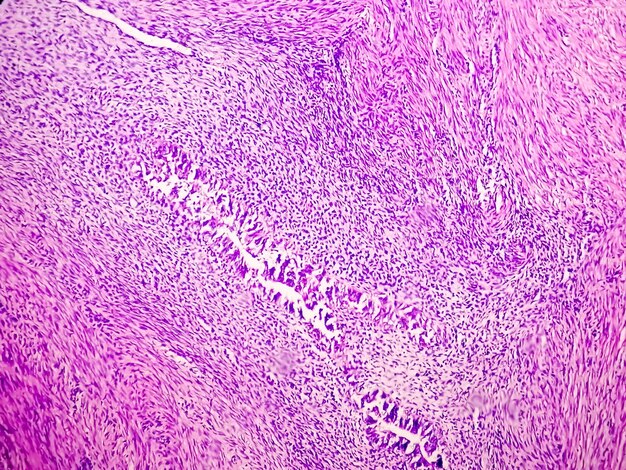 Microfoto of microscopisch beeld van kernbiopsie met adenocarcinoom