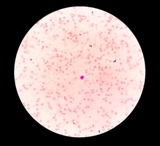 Microfoto van een hematologisch objectglaasje waarop bicytopenie te zien is