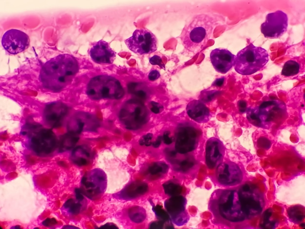 Microfoto van gemetastaseerd adenocarcinoom van de long