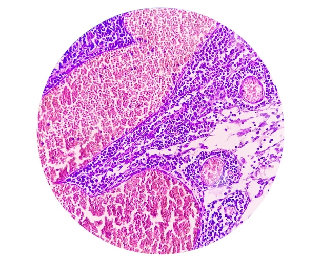 Foto microfoto van maag adenocarcinoom. maag adenocarcinoom.