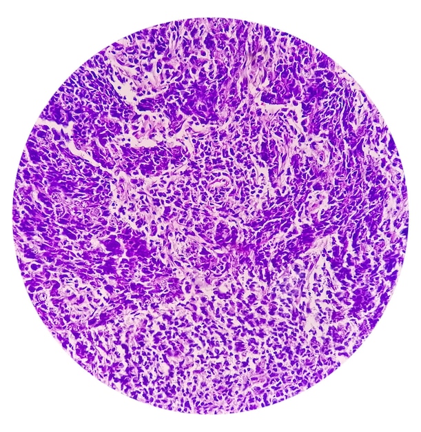 Microfoto van nasofarynxcarcinoom of nasopharynxkanker